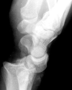 Barton fracture (volar shear of distal radius)