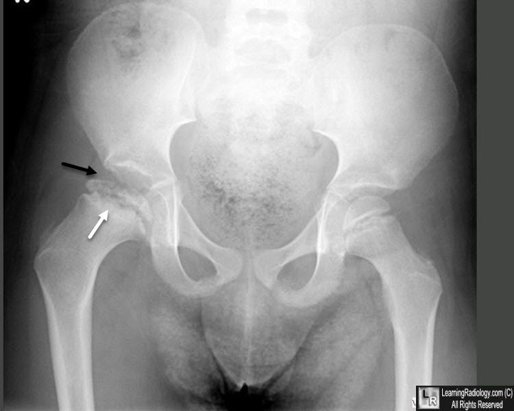 Legg-Calvé-Perthes disease