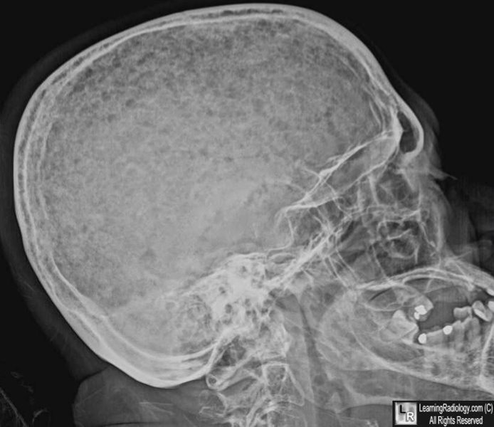 Multiple myeloma (skull lytic lesions)
