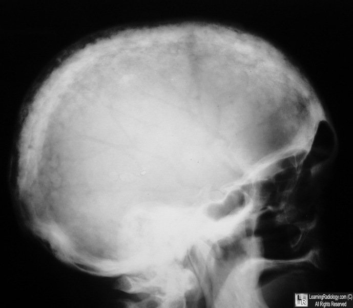 Paget disease of skull (cotton-wool appearance)