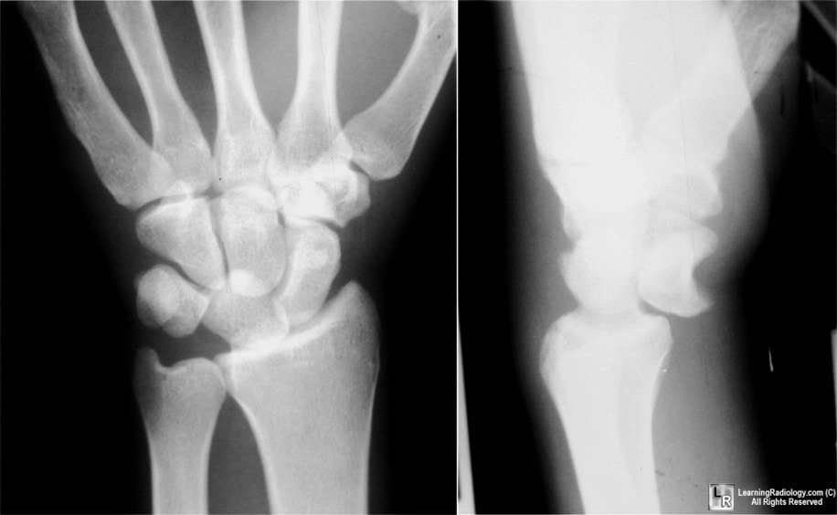 Perilunate dislocation