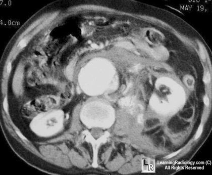 Ruptured abdominal aortic aneurysm