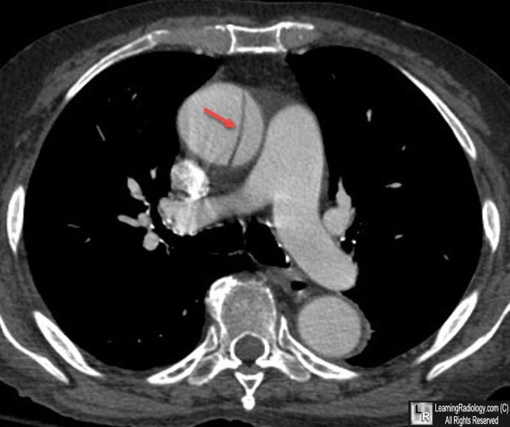 Aortic dissection (Stanford Type A)