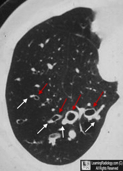 Bronchiectasis (signet ring sign)