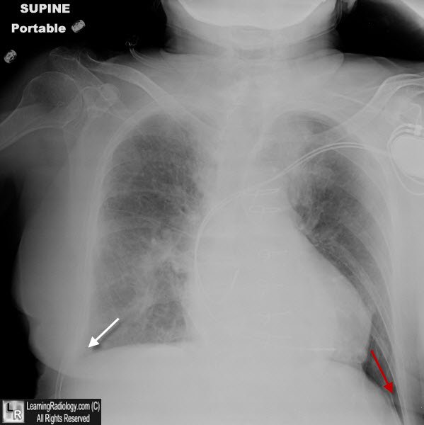 Deep sulcus sign (supine pneumothorax)