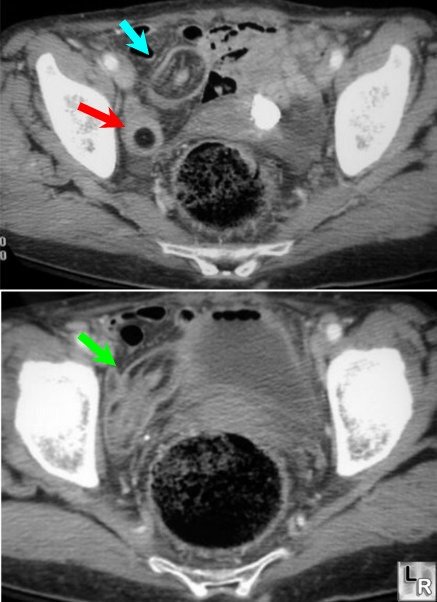 Intussusception (target sign)
