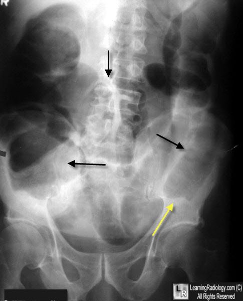 Large bowel obstruction