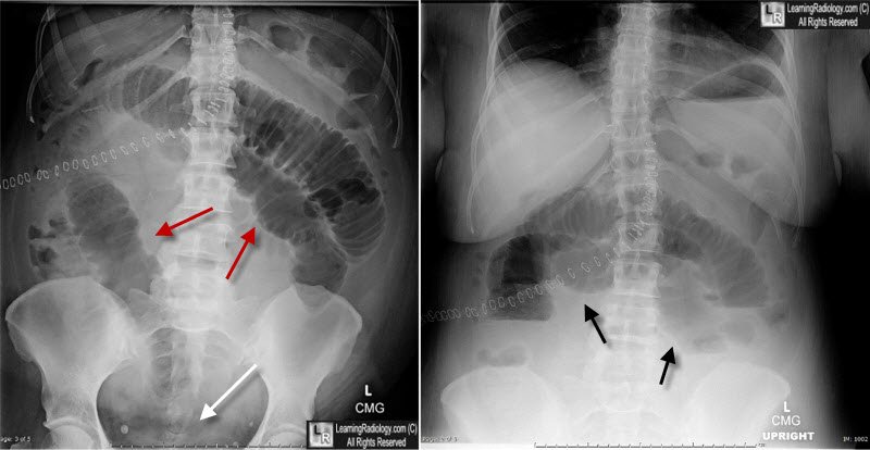 Small bowel obstruction