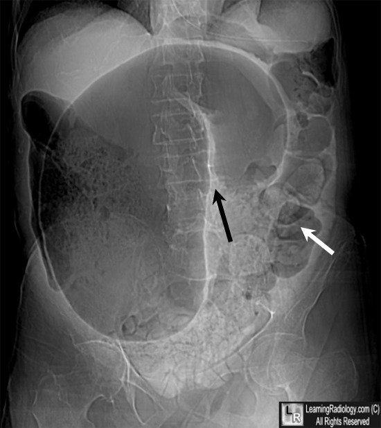 Sigmoid volvulus (coffee bean sign)