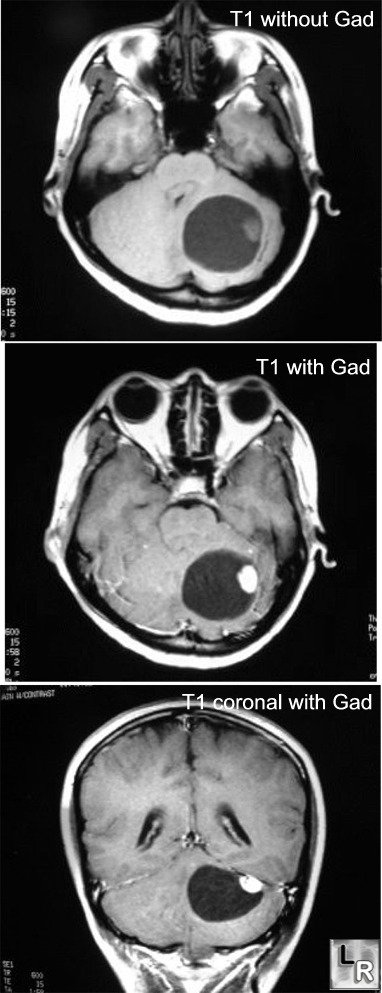 Cerebellar haemangioblastoma