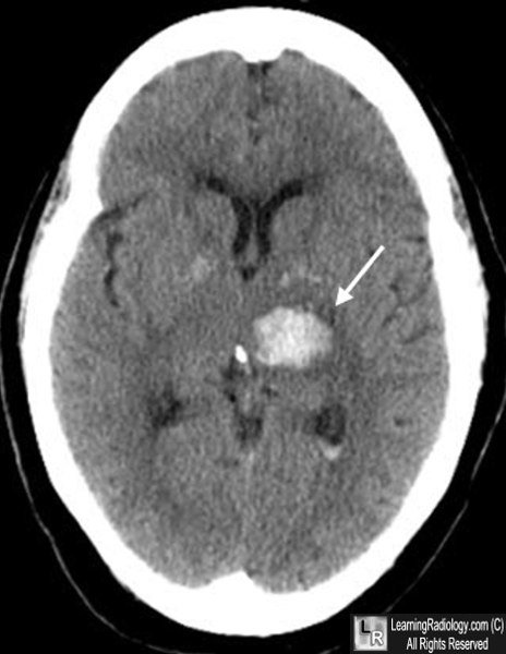 Haemorrhagic stroke (intracerebral haemorrhage)