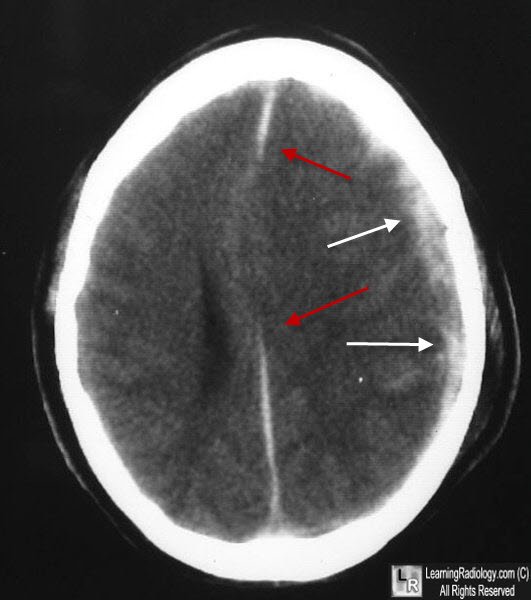 Acute subdural haematoma
