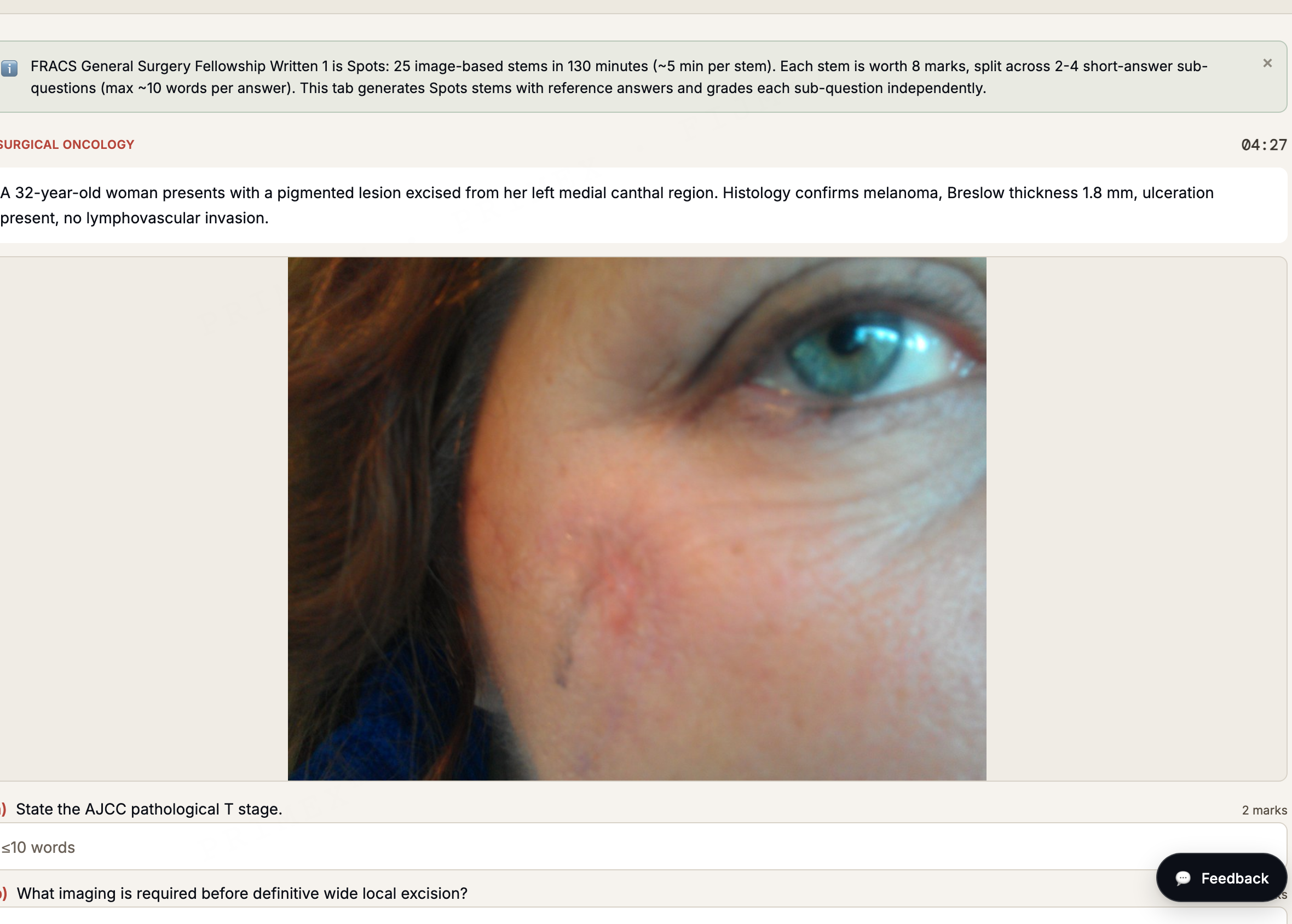 FRACS General Surgery Spots stem: an image-based melanoma case with short-answer sub-questions