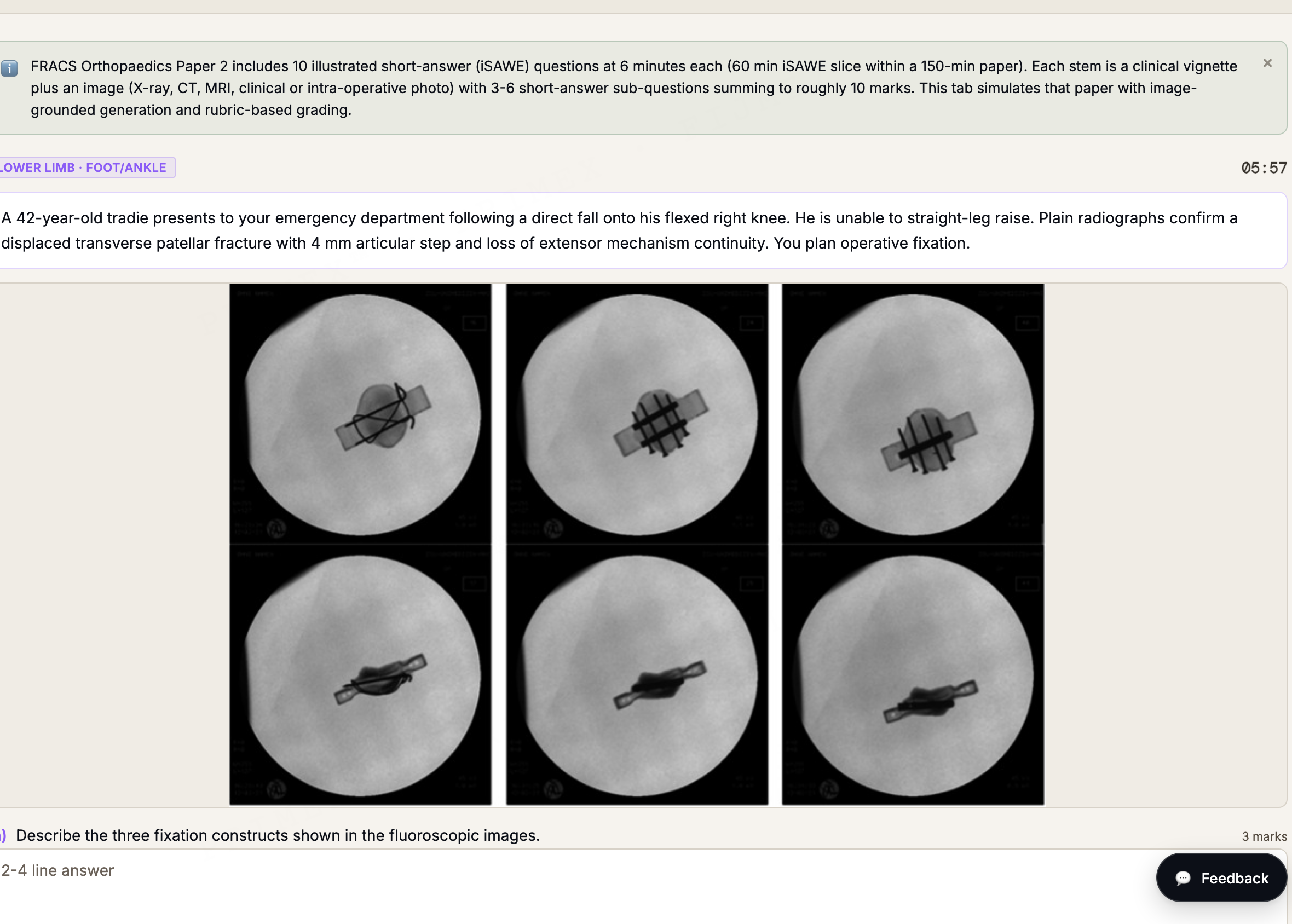 FRACS Orthopaedics iSAWE station: a patellar fracture vignette with fluoroscopic fixation images and graded sub-questions